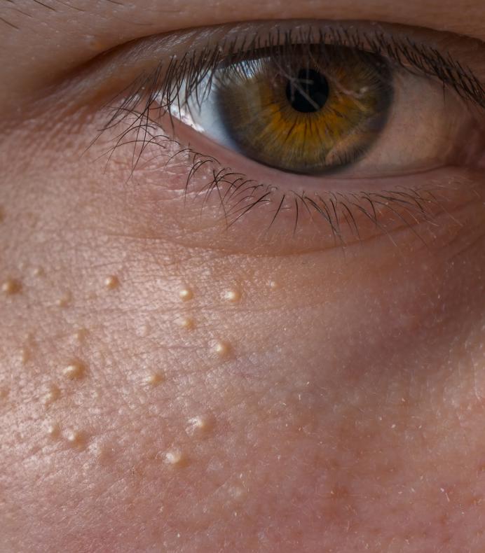 Milia - Dynamic Beauty